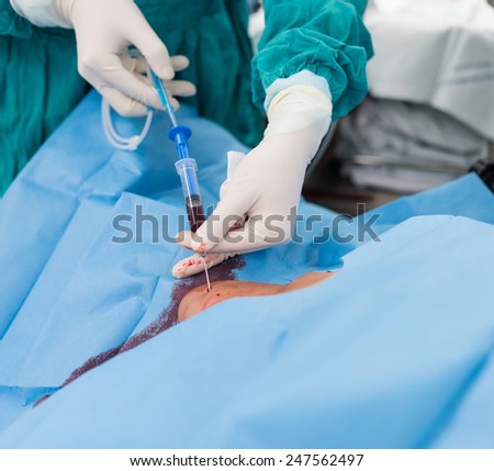 doctor apply guide wire to carotid vein