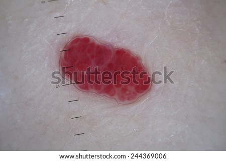Hemangioma benign tumor of blood vessels, often forming a red birthmark