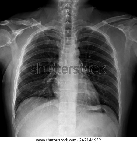 film x-ray right clavicle(collarbone ) : show fracture right clavicle.