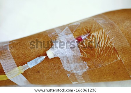 Patient getting drug  intravenous injection at arm