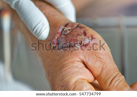 Dog bite hand wound was infection.