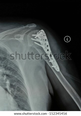 Left arm fractures fixed X-ray after surgery