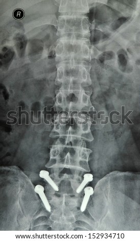 After the operation of lumbar disc prolapse X-ray positive position