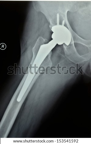 After X-ray artificial femoral head replacement surgery, side photos
