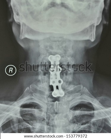 Cervical bone hyperplasia after surgery, X-ray of cervical vertebra is a photo
