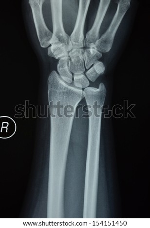 Wrist, forearm x-rays