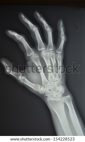The palm of your hand, left oblique position X-ray