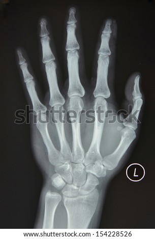 Left hand X-ray, positive