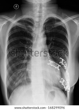 On the left side of the chest rib fractures fixed postoperative x-rays