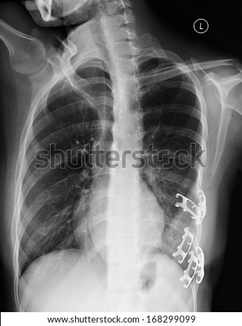 The left chest rib fractures, left anterior oblique position X-ray pictures