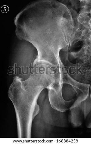 Right hip X-ray, is location
