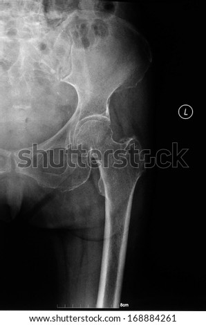 X-ray left hip, is location