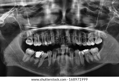 Panoramic X-ray teeth of a human body