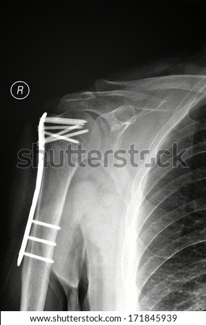 His right arm fracture fixed X-ray photograph