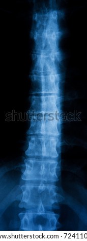 Radiograph of a human spine.