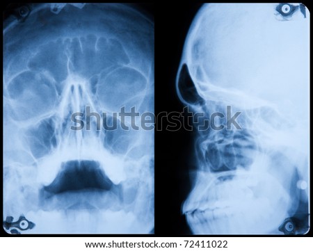 Radiograph of a human skull, front and lateral view.