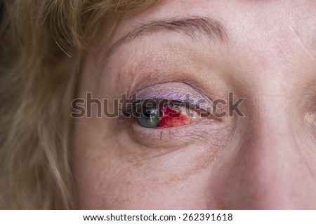 Bleeding in the eye, horizontal macro shot, health background