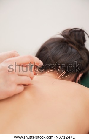 Acupuncture needles on back of a young woman at the spa