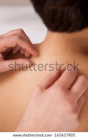 Acupuncture needles in the back as tcm treatment