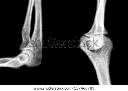xray pathology human elbow on dark background