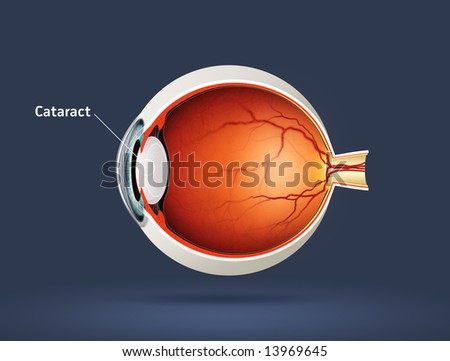 Cataract Disease