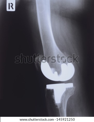 X-ray, Total knee replacement