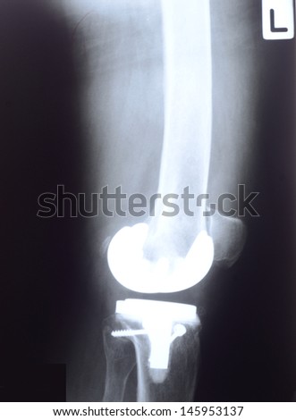 X-ray, total knee replacement