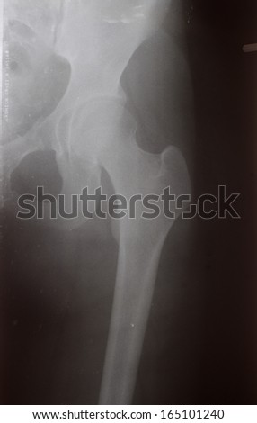 X-ray : Hip