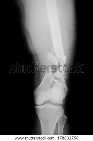 X-ray of a broken leg,fracture femur