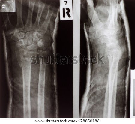 X-ray of a broken arm on splint, fracture ulnar