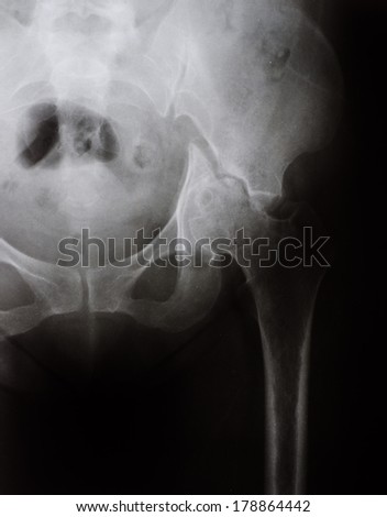 X-ray of a broken hip. fracture pelvic