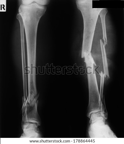 X-ray of both broken legs, fracture tibia and fibula