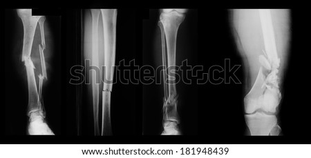 Collection X-ray of a broken leg