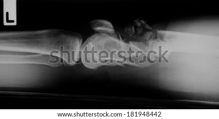 X-ray of a broken arm, fracture humerus