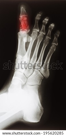 X-ray of a broken big toe