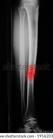 X-ray of a broken leg, fracture tibia