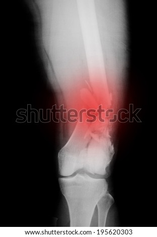 X-ray of a broken leg,fracture femur