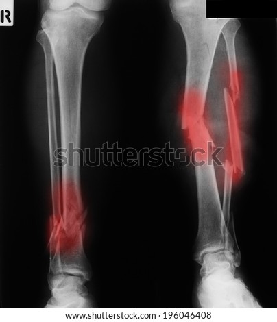 X-ray of both broken legs, fracture tibia and fibula