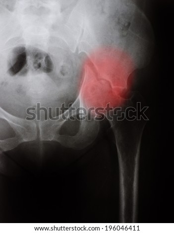 X-ray of a broken hip. fracture pelvic
