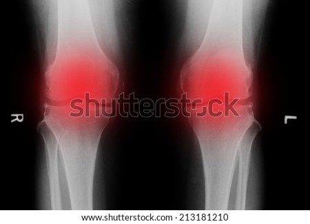 X-ray of a knee, painful