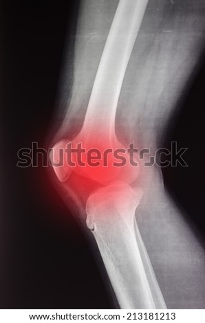 X-ray of a knee, painful