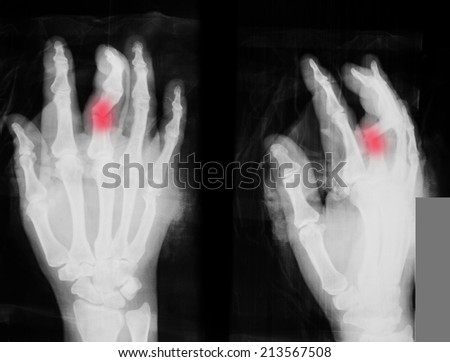 X-ray of broken finger