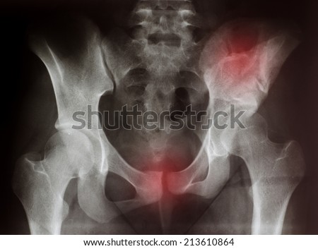 X-ray of a broken pelvic