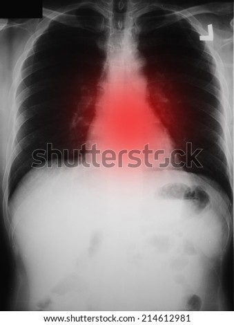 X-ray : Chest pain
