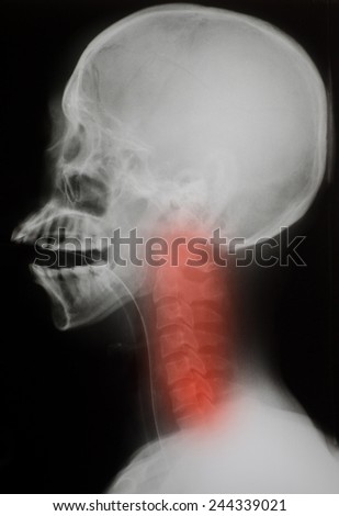 X-ray : Lateral skull - neck injury
