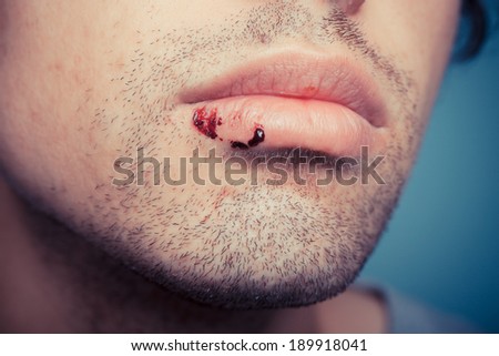 Young man with dried blood from a cold sore on his lip