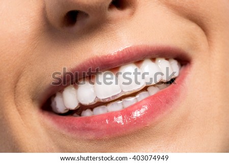 Smiling girl wearing invisible teeth braces close up
