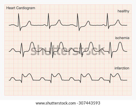 Heart Cardiogram Waves. Three Types Of Cardiograms: Healthy Heart 