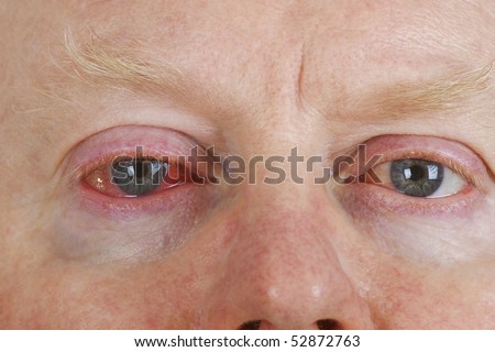 Close up shot from  man\'s wrinkled tired irritated bloodshot eye.