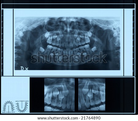 Panoramic radiography of children  denture - 9 years